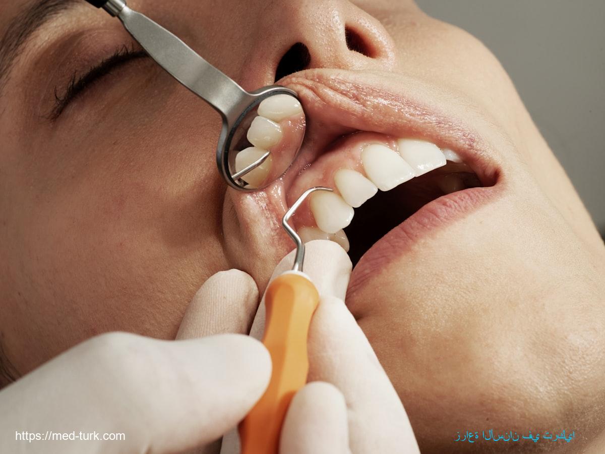 Dental Implants in Turkey